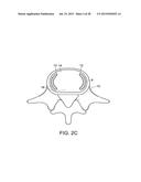 IN-SITU FORMED INTERVERTEBRAL FUSION DEVICE AND METHOD diagram and image