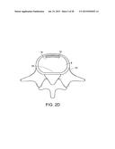 IN-SITU FORMED INTERVERTEBRAL FUSION DEVICE AND METHOD diagram and image