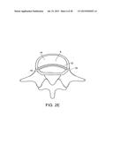 IN-SITU FORMED INTERVERTEBRAL FUSION DEVICE AND METHOD diagram and image