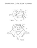 IN-SITU FORMED INTERVERTEBRAL FUSION DEVICE AND METHOD diagram and image