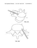 IN-SITU FORMED INTERVERTEBRAL FUSION DEVICE AND METHOD diagram and image