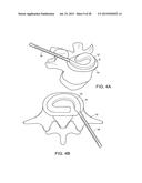 IN-SITU FORMED INTERVERTEBRAL FUSION DEVICE AND METHOD diagram and image