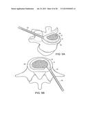 IN-SITU FORMED INTERVERTEBRAL FUSION DEVICE AND METHOD diagram and image