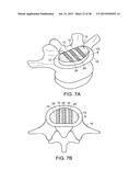 IN-SITU FORMED INTERVERTEBRAL FUSION DEVICE AND METHOD diagram and image