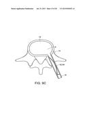 IN-SITU FORMED INTERVERTEBRAL FUSION DEVICE AND METHOD diagram and image