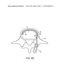 IN-SITU FORMED INTERVERTEBRAL FUSION DEVICE AND METHOD diagram and image