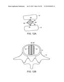 IN-SITU FORMED INTERVERTEBRAL FUSION DEVICE AND METHOD diagram and image