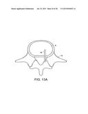 IN-SITU FORMED INTERVERTEBRAL FUSION DEVICE AND METHOD diagram and image