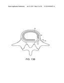 IN-SITU FORMED INTERVERTEBRAL FUSION DEVICE AND METHOD diagram and image