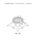 IN-SITU FORMED INTERVERTEBRAL FUSION DEVICE AND METHOD diagram and image