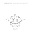 IN-SITU FORMED INTERVERTEBRAL FUSION DEVICE AND METHOD diagram and image