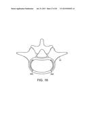 IN-SITU FORMED INTERVERTEBRAL FUSION DEVICE AND METHOD diagram and image