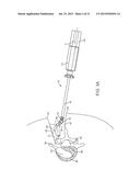 INSERTION HANDLE FOR SURGICAL IMPLANTS diagram and image