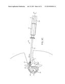 INSERTION HANDLE FOR SURGICAL IMPLANTS diagram and image