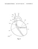 Graft Devices and Related Systems and Methods diagram and image