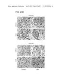 METHODS AND COMPOSITIONS FOR TREATING ANTIPROGESTIN-RESISTANT CANCERS diagram and image