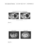 ADENOVIRAL VECTORS AND METHODS AND USES RELATED THERETO diagram and image