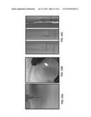 OMENTUM BASED SCAFFOLD AND DELIVERY SYSTEM diagram and image