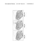 KIT, USE THEREOF AND METHOD FOR FILLING CONNECTIVE TISSUE OF THE SKIN diagram and image