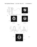 METHOD AND APPARATUS FOR EXTRACTION AND QUANTIFICATION OF HEMATOMA FROM A     BRAIN SCAN SUCH AS COMPUTED TOMOGRAPHY DATA diagram and image