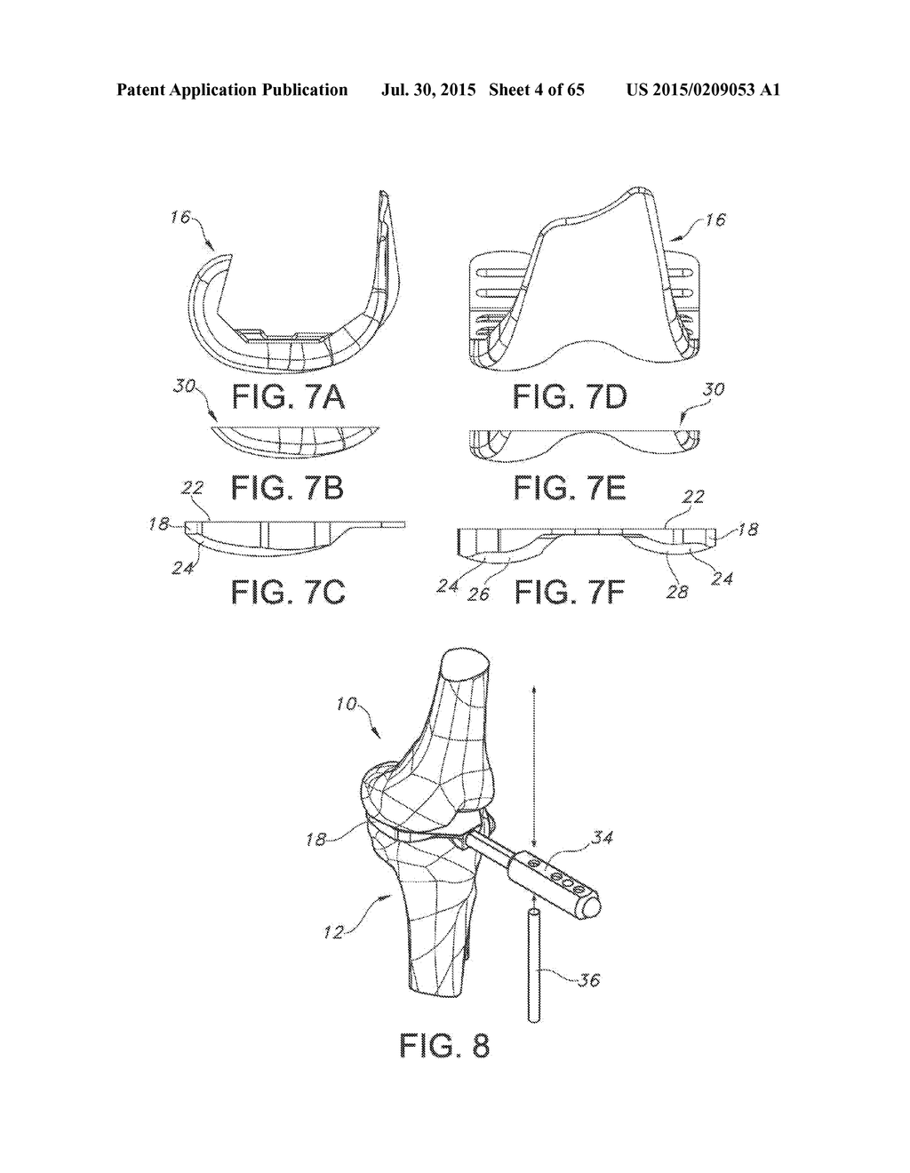 METHODS AND APPARATUS FOR PERFORMING KNEE ARTHROPLASTY - diagram, schematic, and image 05