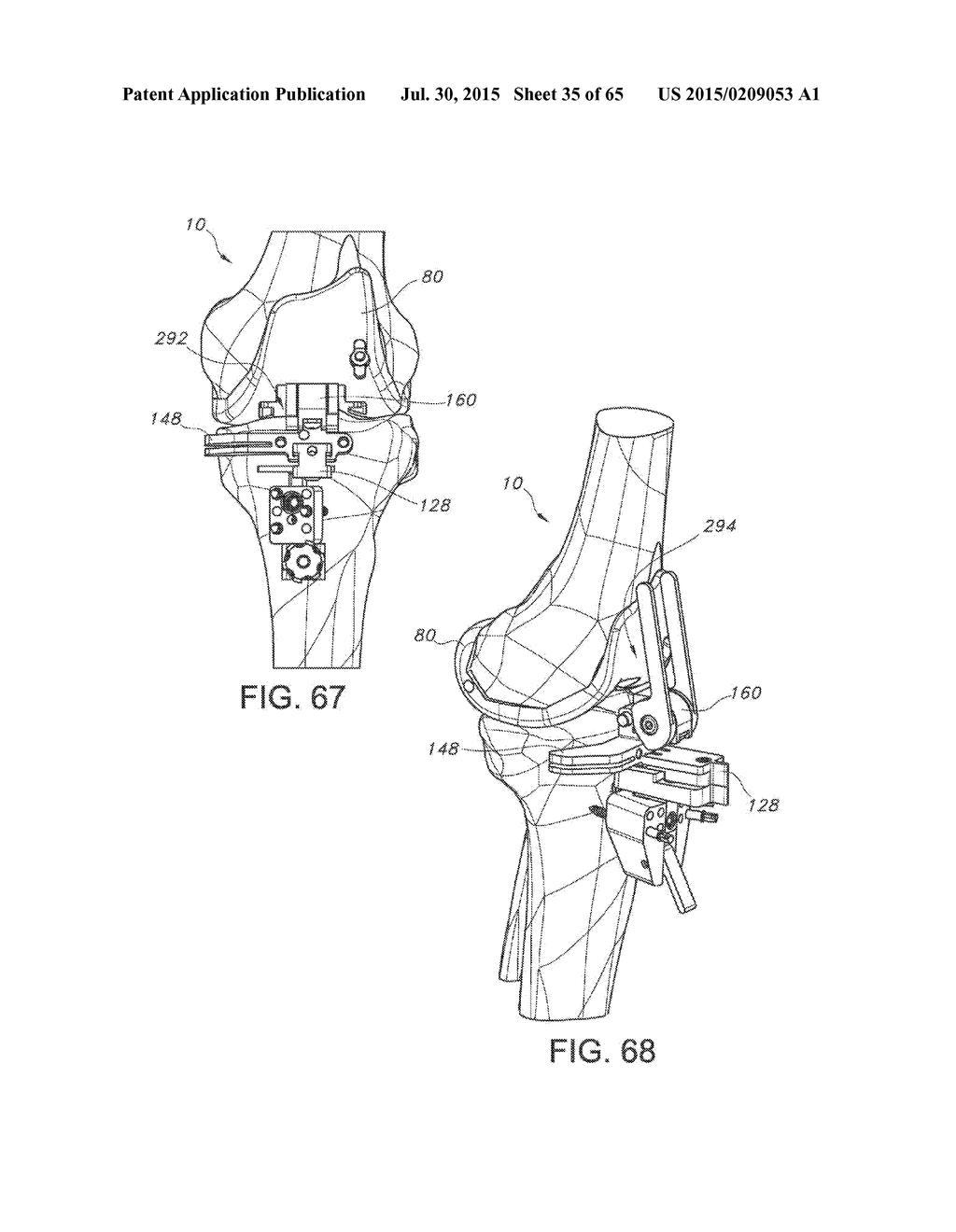 METHODS AND APPARATUS FOR PERFORMING KNEE ARTHROPLASTY - diagram, schematic, and image 36