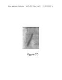 SYSTEMS FOR USE IN CROSSING AND TREATING AN OCCLUSION diagram and image