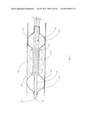 COOLED MICROWAVE DENERVATION CATHETER CONFIGURATION diagram and image