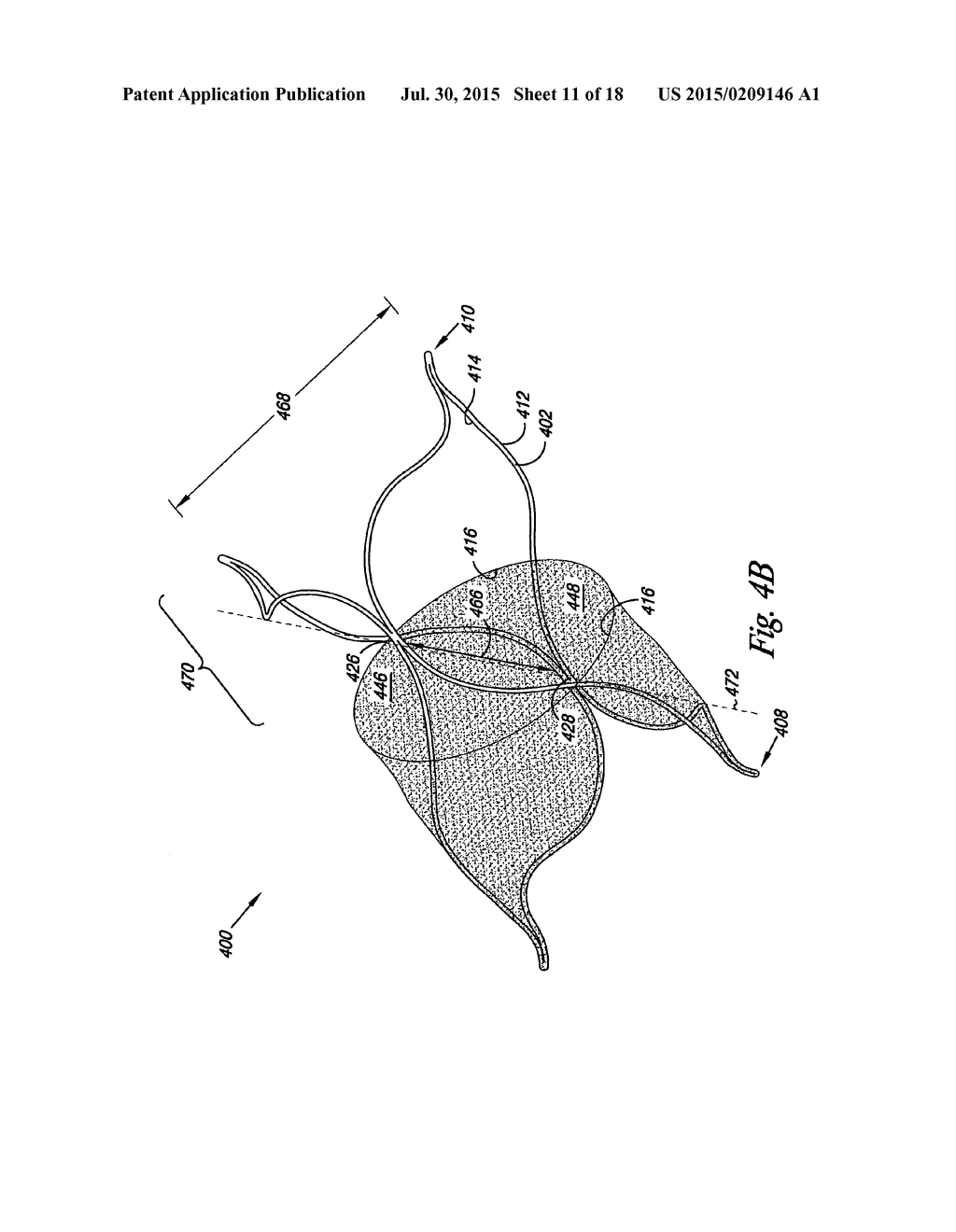 Venous Valve, System, and Method - diagram, schematic, and image 12