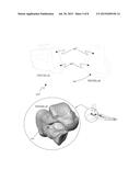 SYSTEM AND METHOD FOR MODIFYING TALOCALCANEAL RELATIONSHIP IN A FOOT diagram and image