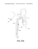 BLOOD PUMP SYSTEMS AND METHODS diagram and image