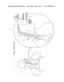 METHOD OF DETECTING ENDOTRACHEAL TUBE MISPLACEMENT diagram and image