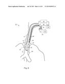 METHOD OF DETECTING ENDOTRACHEAL TUBE MISPLACEMENT diagram and image