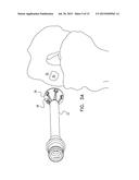 TREATMENT OF CAVITIES IN A HUMAN BODY diagram and image