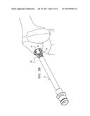 TREATMENT OF CAVITIES IN A HUMAN BODY diagram and image