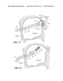 ACCESSORY TO ALLOW SENSING AT BALLOON INTERFACE diagram and image