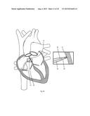 Radiofrequency Perforation Apparatus diagram and image