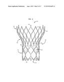 REPOSITIONING OF PROSTHETIC HEART VALVE AND DEPLOYMENT diagram and image