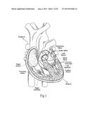 RAPID DEPLOYMENT METHODS FOR PROSTHETIC HEART VALVES diagram and image