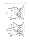 RAPID DEPLOYMENT METHODS FOR PROSTHETIC HEART VALVES diagram and image