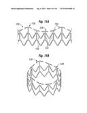 RAPID DEPLOYMENT METHODS FOR PROSTHETIC HEART VALVES diagram and image