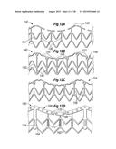 RAPID DEPLOYMENT METHODS FOR PROSTHETIC HEART VALVES diagram and image