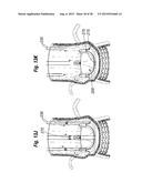 RAPID DEPLOYMENT METHODS FOR PROSTHETIC HEART VALVES diagram and image