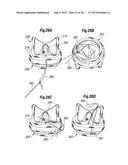 RAPID DEPLOYMENT METHODS FOR PROSTHETIC HEART VALVES diagram and image