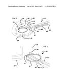 Capsulotomy Cartridge diagram and image