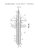 METHOD OF DELIVERING A TRANSSEPTAL CANNULA TO A HEART diagram and image