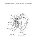 THERMALLY ASSISTED PULSED ELECTRO-MAGNETIC FIELD STIMULATION DEVICE AND     METHOD FOR TREATMENT OF OSTEOARTHRITIS diagram and image