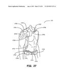 THERMALLY ASSISTED PULSED ELECTRO-MAGNETIC FIELD STIMULATION DEVICE AND     METHOD FOR TREATMENT OF OSTEOARTHRITIS diagram and image