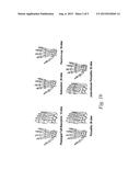 USE OF TNFALPHA INHIBITOR FOR TREATMENT OF PSORIATIC ARTHRITIS diagram and image