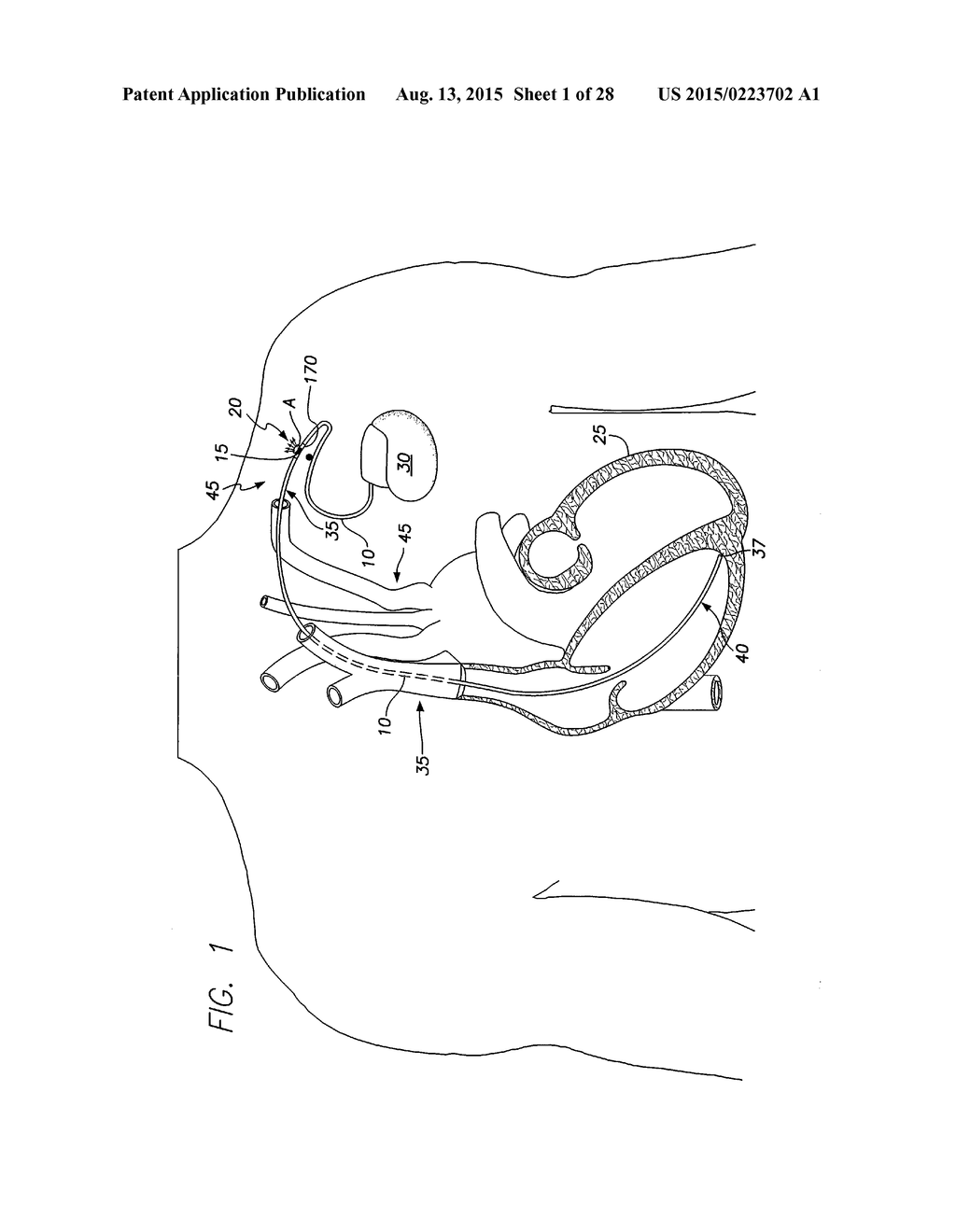 IMPLANTABLE ECHO DOPPLER FLOW SENSOR FOR MONITORING OF HEMODYNAMICS - diagram, schematic, and image 02